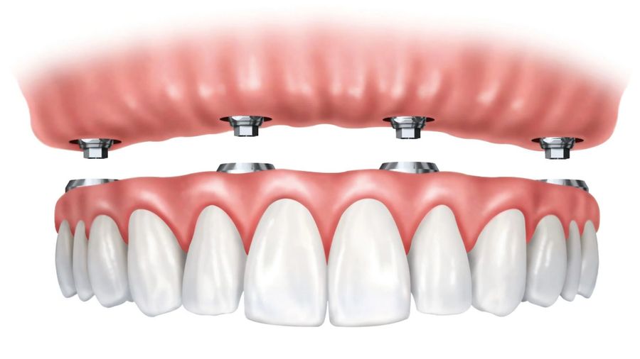 All-on-four implants Budapest, Hungary