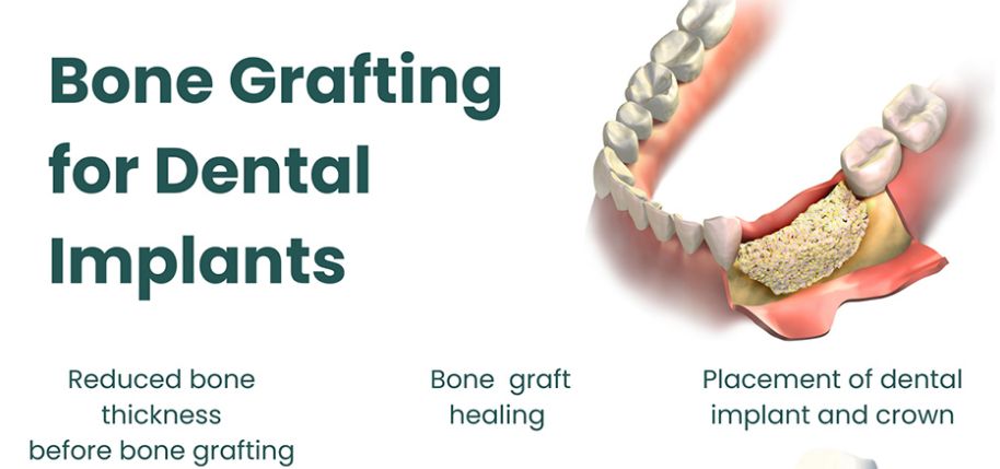 Bone grafting and bone replacement for dental treatments