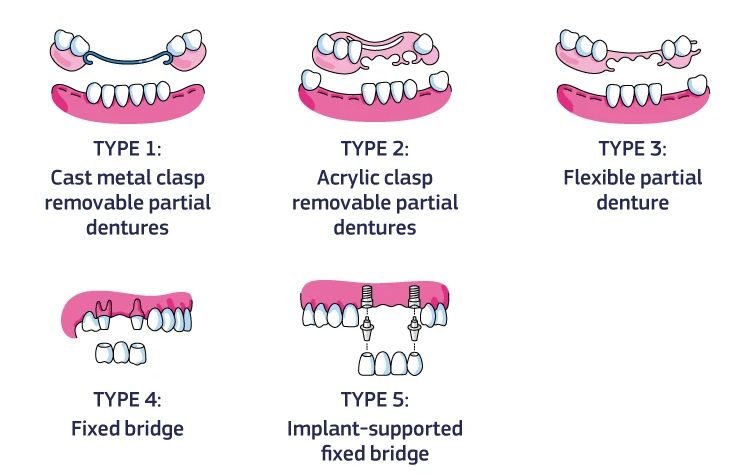 Types of dentures - full arch reconstructions in Budapest