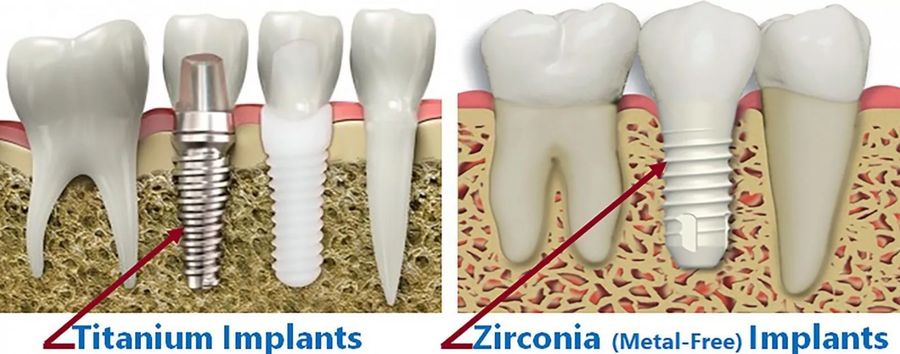 Metal free porcelain implants