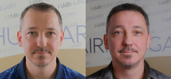 Hair transplant Budapest, Hungary before after pictures