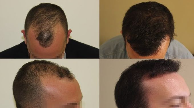 FUE abroad - before-after hair transplant photos
