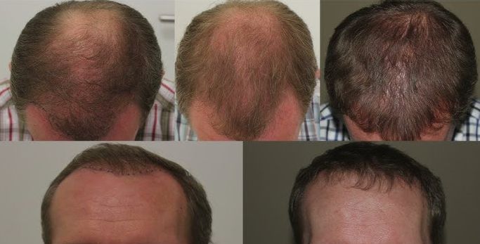 FUE hair restoration before after photos