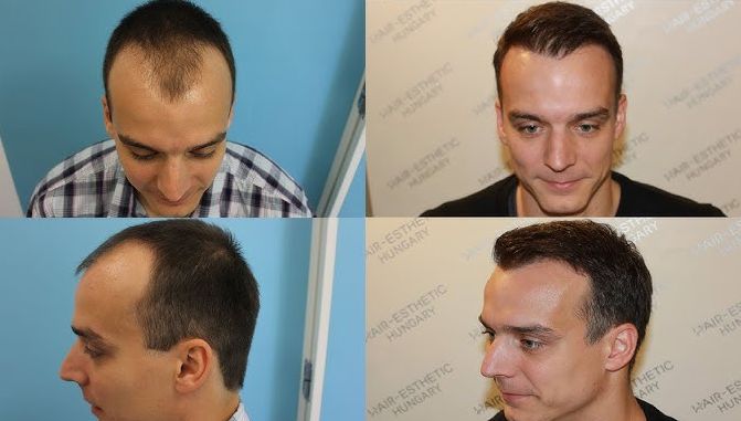FUE hair transplant bfore and after images