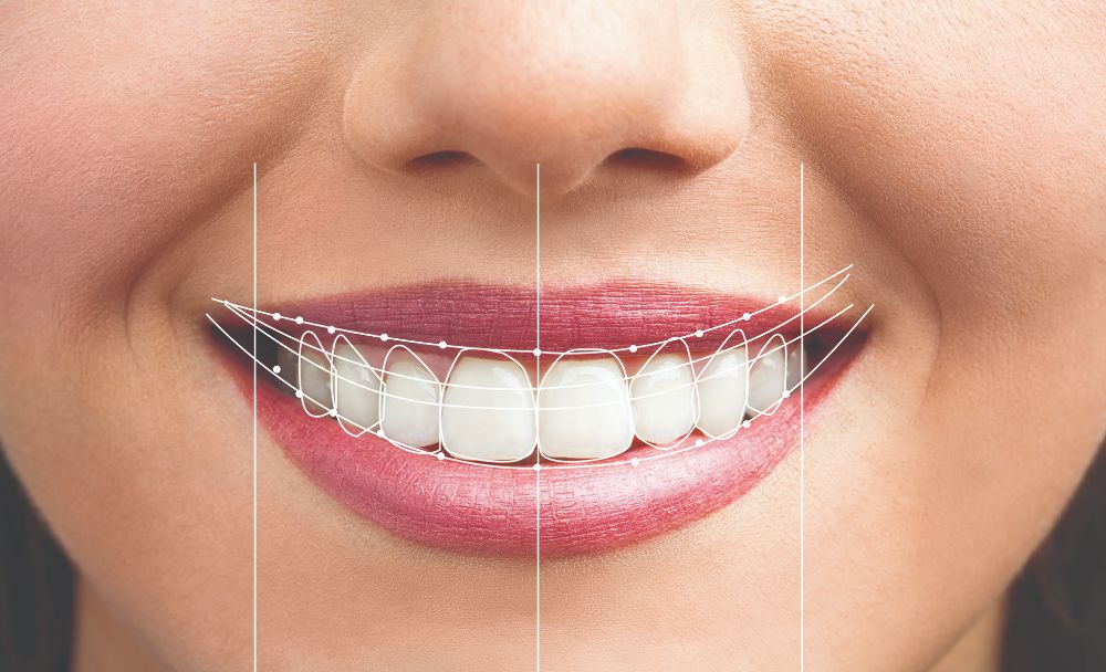 smile design with intraoral camera